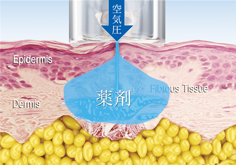 薬剤注入