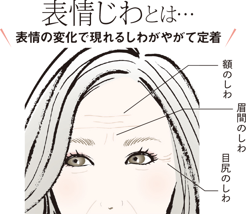 額、眉間、目尻の表情じわを記したイラスト