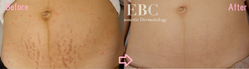 妊娠線ができていたお腹と治療で消えたお腹の比較写真