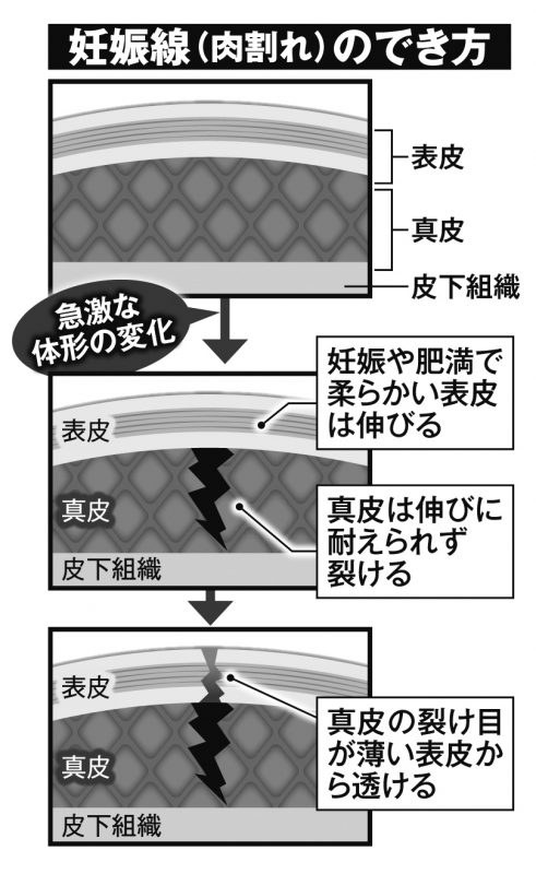 妊娠線（肉割れ）のでき方を図解している