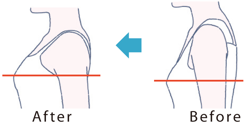 着用する前後の比較イラスト