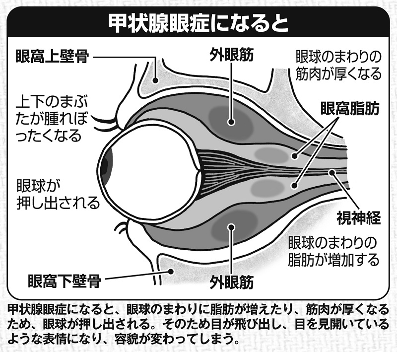 甲状腺眼症になるとどうなるか、図解