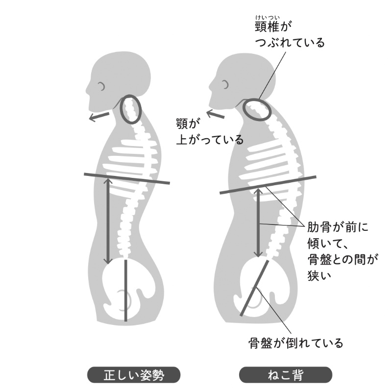 正しい姿勢と猫背姿勢の骨格イラスト