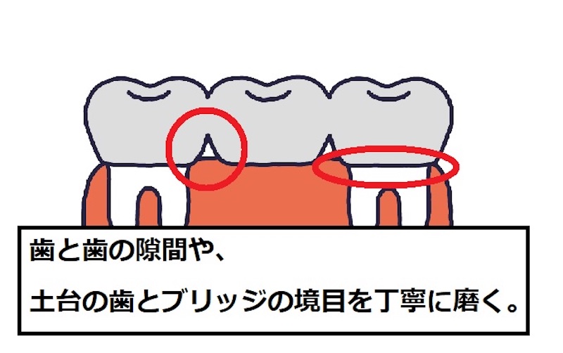 歯とブリッジの間を優しく丁寧に磨いて