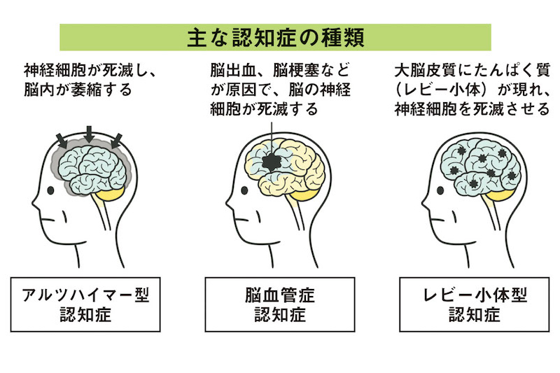 主な認知症の種類を表した図