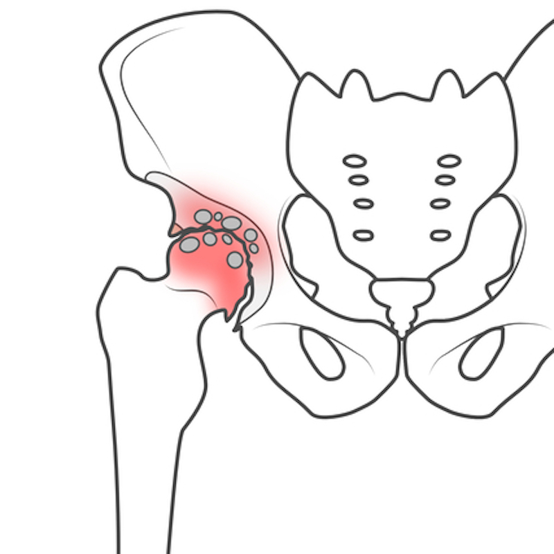 股関節が痛む原因を解説