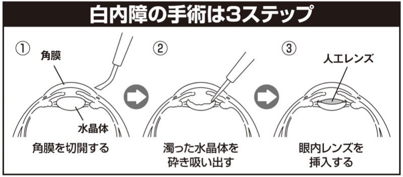 白内障手術の3ステップとは