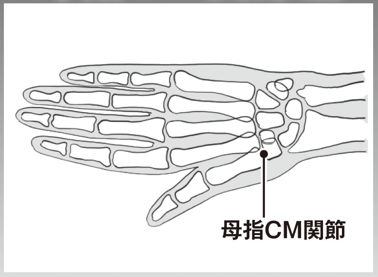 母指CM関節症（イラスト／飛鳥幸子）