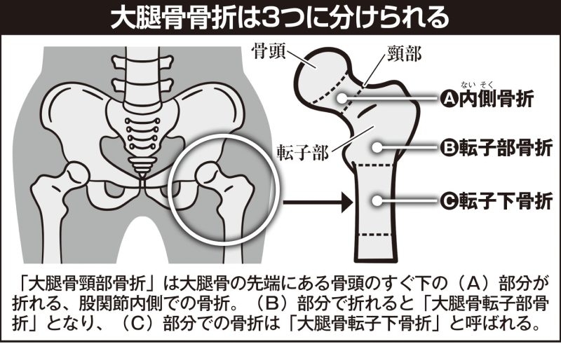 大腿骨骨折は3つに分けられる