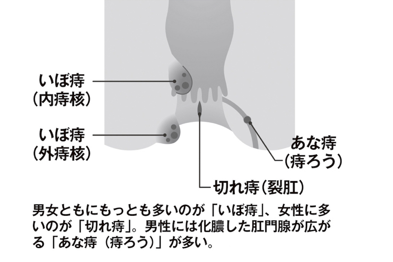 痔は大きく3種類ある