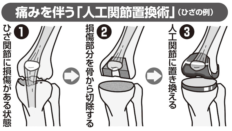 痛みを伴う「人工関節置換術」（ひざの例）