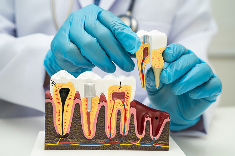 歯周病が悪化すると、あごの骨が溶けて歯が抜け落ちる（写真／PIXTA）
