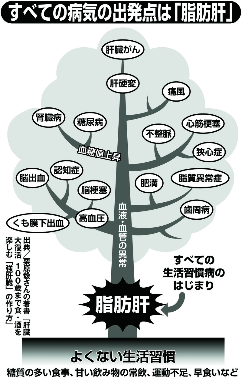 すべての病気の出発点は「脂肪肝」