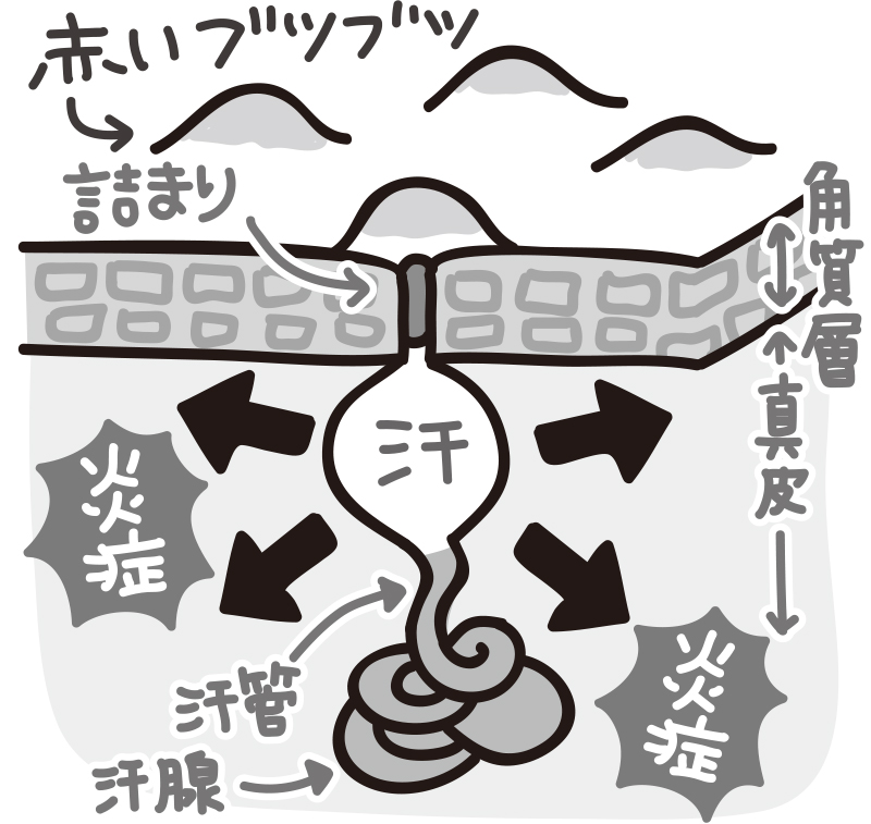あせものメカニズム