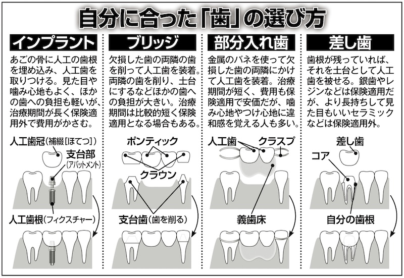「歯」を失った場合の治療