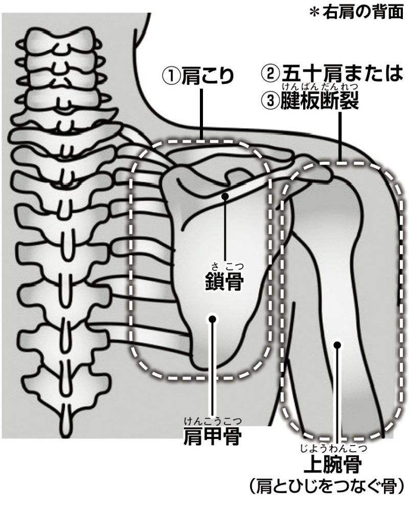 痛みが出る場所の違い