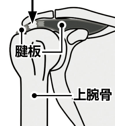 痛みが出る場所の違い（イラスト／アフロ）