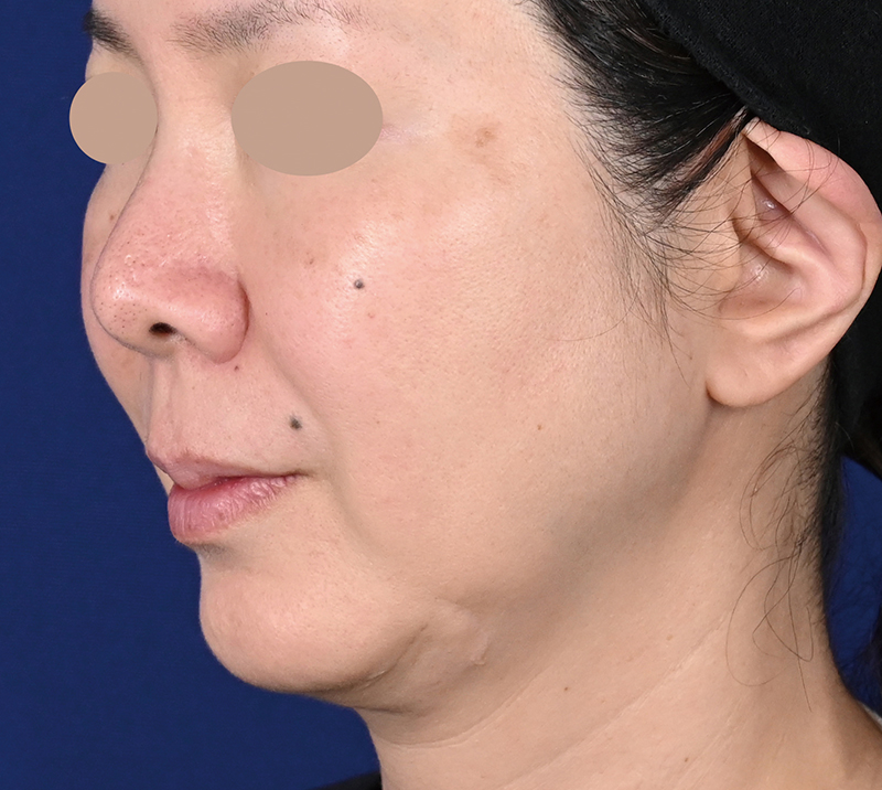 50代女性の場合 施術前