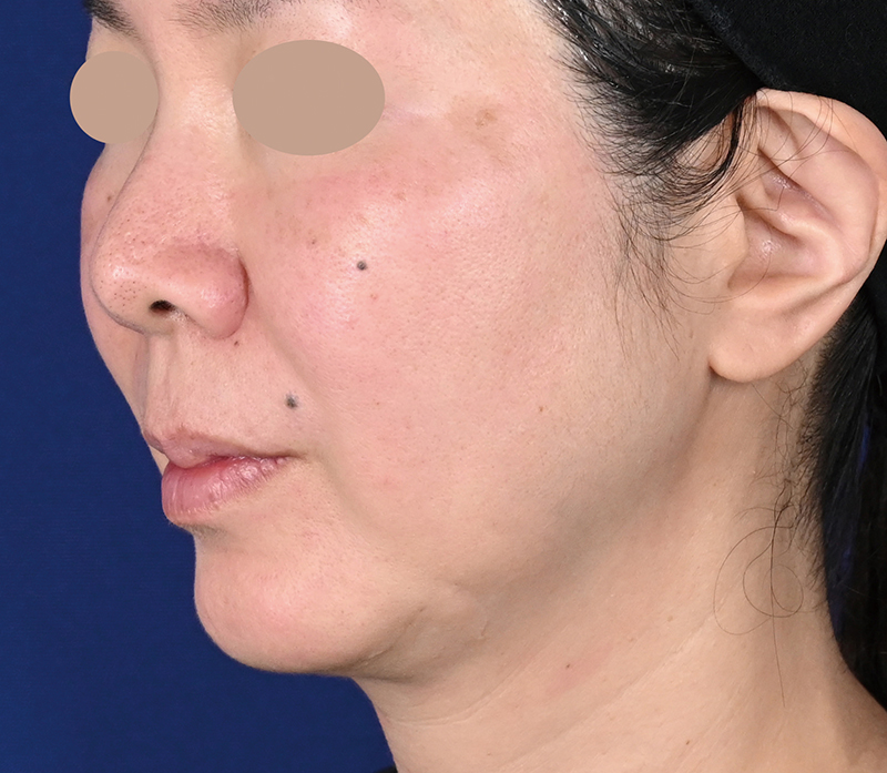 50代女性の場合 施術直後（1 回照射）