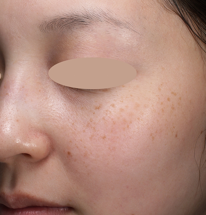 30代女性の場合 施術前