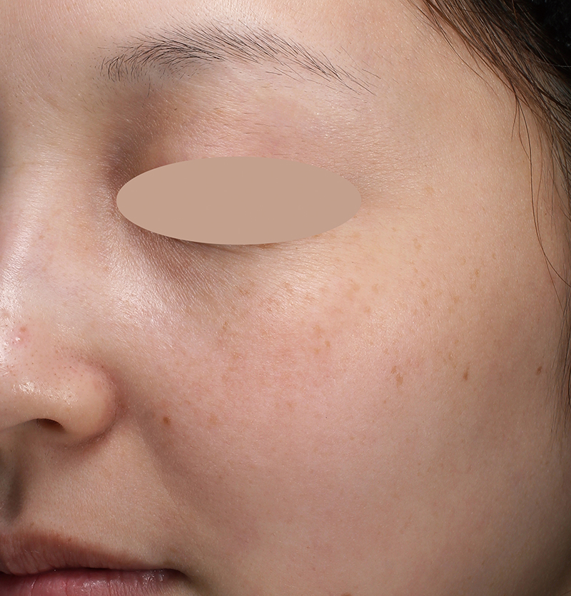 30代女性の場合 1 か月後