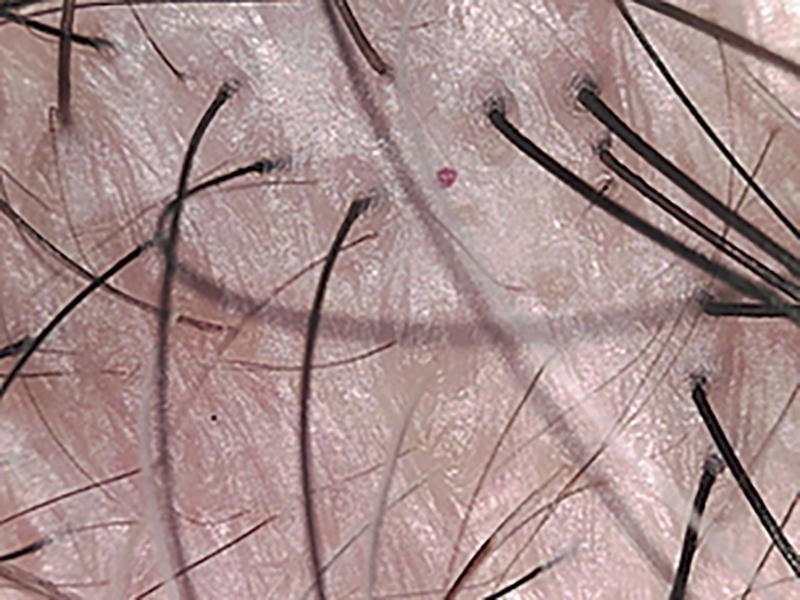 薄毛が進行した頭皮