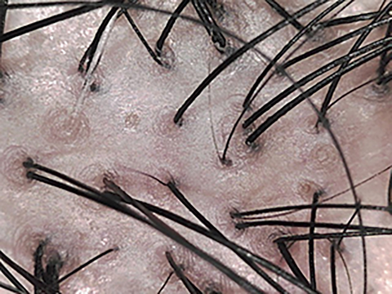 薄毛が進行した頭皮