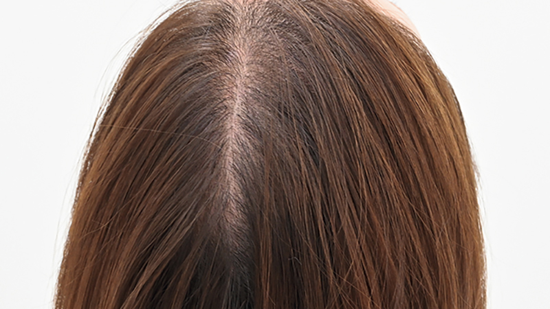 『発毛レーザーFoLix』を6回施術した40代女性