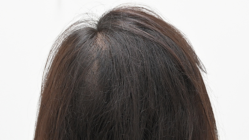 『発毛レーザーFoLix』を6回施術した40代女性