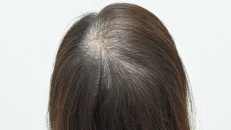『毛根再生治療』を1回施術（ビフォー）