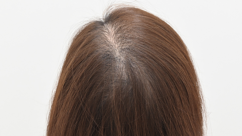 『毛根再生治療』を1回施術（アフター）