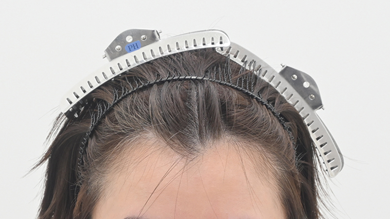 『発毛レーザーFoLix』6回と女性用ミノキシジル内服を併用した40代女性（ビフォー）