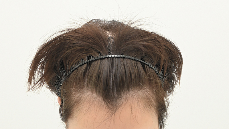 『発毛レーザーFoLix』6回と女性用ミノキシジル内服を併用した40代女性（アフター）