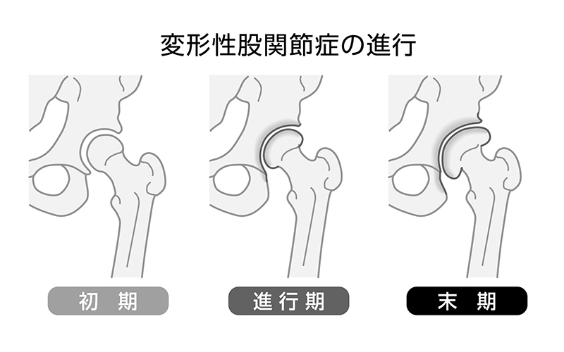 変形性股関節症の進行段階（イラスト／PIXTA）