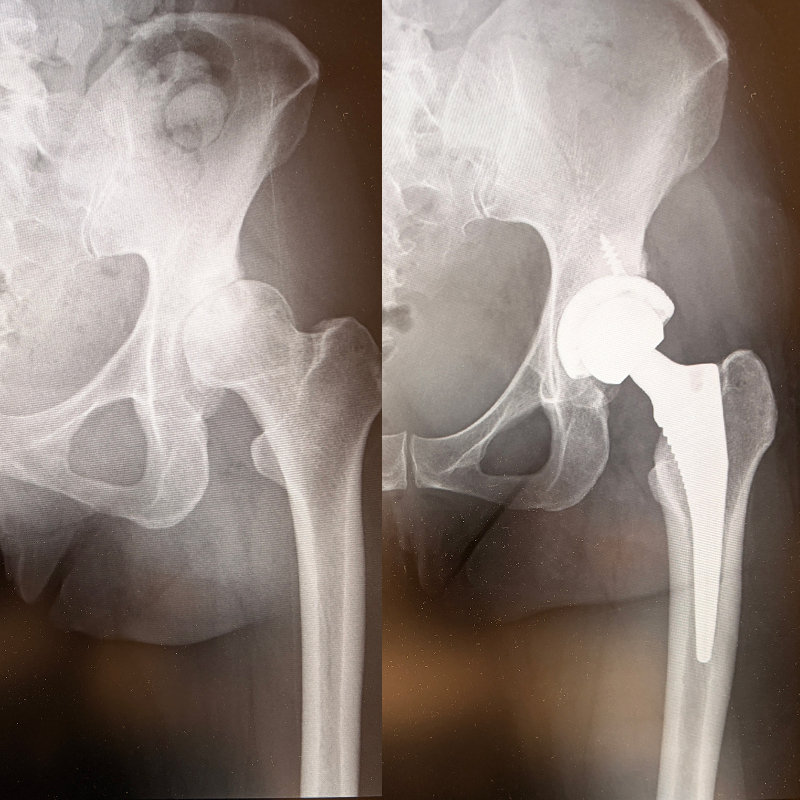 手術ビフォー・アフター（40代女性の例）。ビフォー（左）は臼蓋形成不全のため臼蓋のかぶりが浅く、さらに関節軟骨がすり減り、歩くのもつらい状態（囲み部分）。アフター（右）は人工股関節が入って1年後の状態。海外旅行にも行けるまでになり、骨密度もアップしたという
