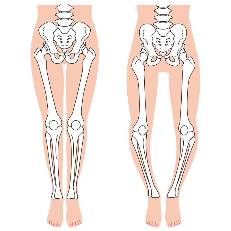 ひざがまっすぐな骨のイラストとひざが開いている骨のイラスト