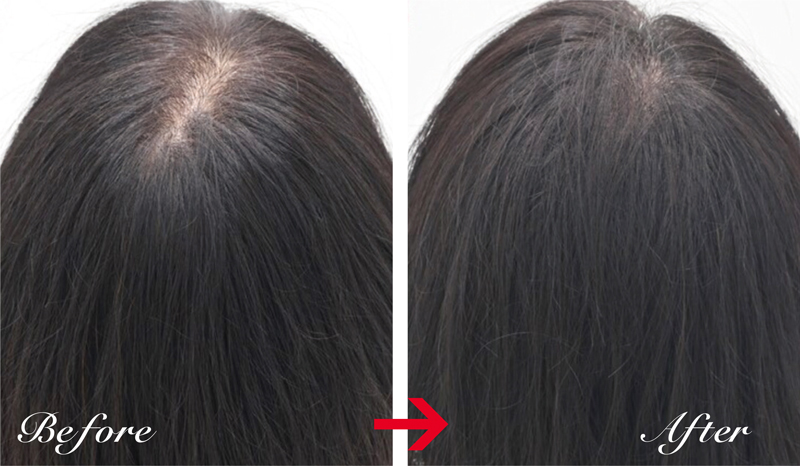 全体的な薄毛が2か月でボリュームアップ。毛根再生注射、臍帯幹細胞培養上清液メソ、女性用薄毛治療薬を併用した55才女性。2か月後には全体の毛量がアップし、頭頂部の透け感も改善