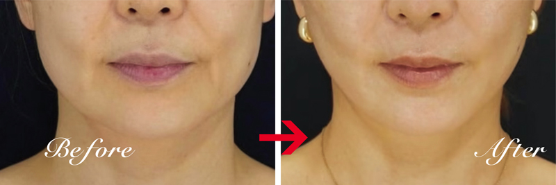 デンシティのビフォーアフター