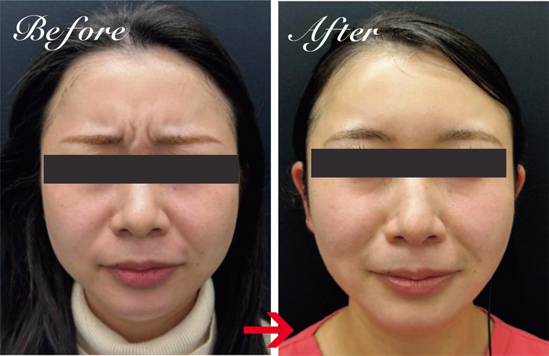 眉間のしわが悩みの女性は、眉間と鼻根にボトックス（アラガン製）を注入。2週間後の写真では眉間に力を入れてもしわがよらず、明るい印象に。早めに注入することで、しわが刻まれるのを予防する効果も。1部位8000円