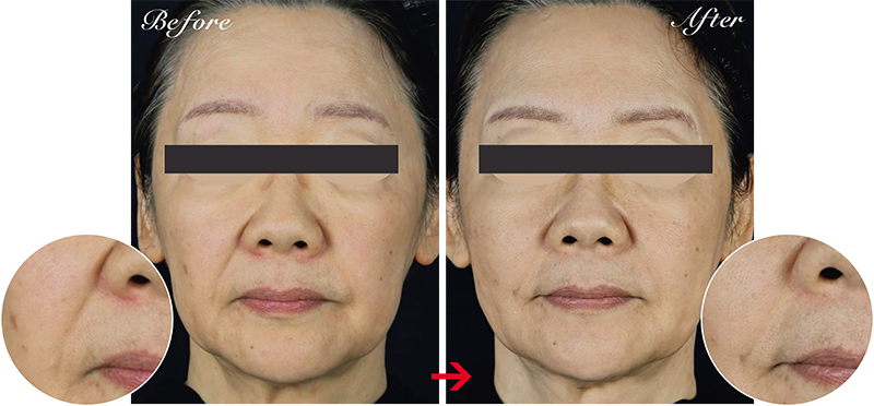 たるみによるほうれい線が目立っていたが、施術後は肌が引き締まり目立たなくなった。肌自体もふっくらみずみずしい印象に。全顔200ショット12万7800円