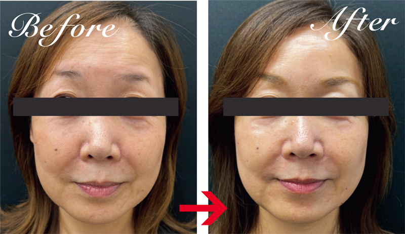 女優注射をした57才女性は、自然な若返りでマイナス5才を目指したいという希望を達成