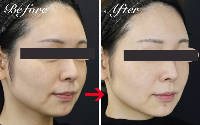 。こめかみや頬のこけに悩む女性は、顔周りにボトックスを併用することで、フェイスラインが滑らかに変化