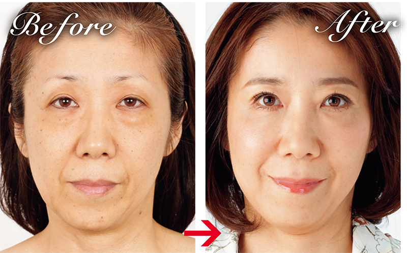 母親の施術では、大きく形を変えずに15才の若返りを叶えるため、目の下のたるみ取り、脂肪吸引や糸リフトでフェイスラインのもたつきを解消するなどの施術を行なった