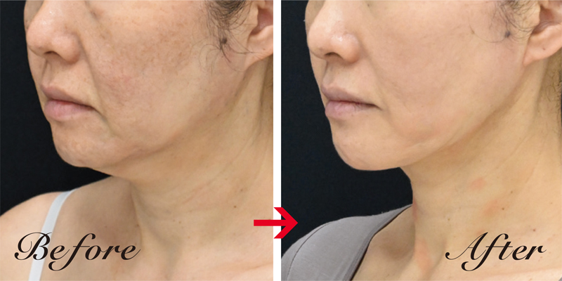 51才女性。頬とあご下を脂肪吸引したことで、たるみによる顔のもたつきが解消されてすっきり。アキーセル脂肪吸引（頬・あご下+エラ下）33万円