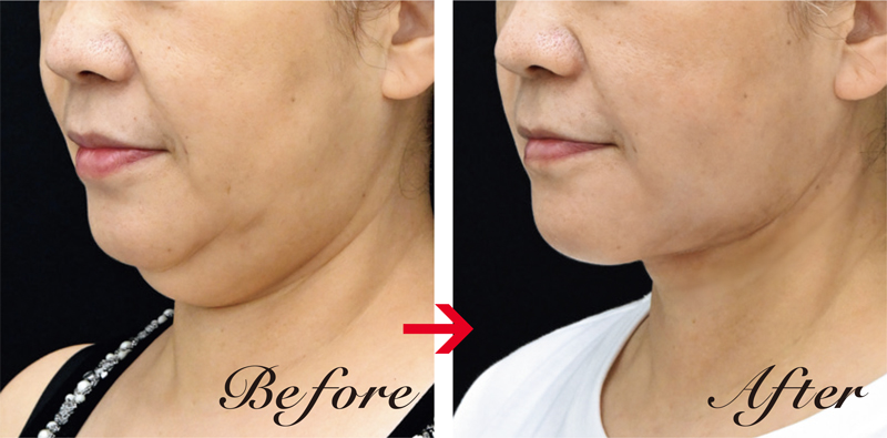 頬とあご下、ジョールファット（口元横から口角下）の脂肪を吸引し、輪郭がシャープに。二重あごも解消した（RF引き締め治療、糸リフトなどを併用）。アキーセル脂肪吸引（頬・あご下+エラ下）33万円