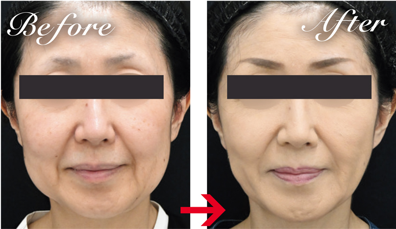 全体を引き上げるプリマリフト（2本1万9200円〜）など3種類の糸を使用