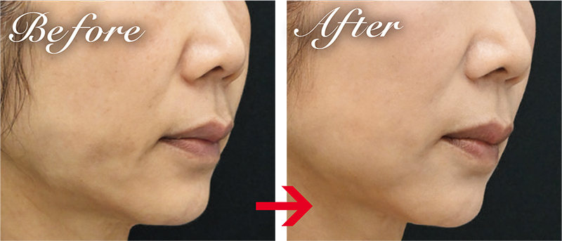 脂肪注入で頬をふっくらと。肌も滑らかに整い、若々しい印象に。