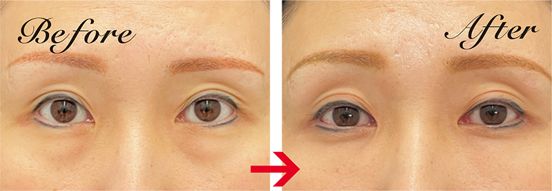 裏ハムラ法で目の下の眼窩脂肪を再配置し、膨らみをフラットに改善。裏ハムラ38万円