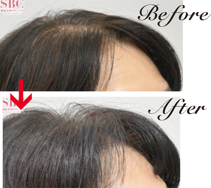 10年来の悩みがわずか6か月で解消。毛根再生注射、臍帯幹細胞培養上清液メソ、C-PRPメソセラピー、女性用薄毛治療薬を併用した63才女性。10年前から悩んでいた頭頂部がボリュームアップ