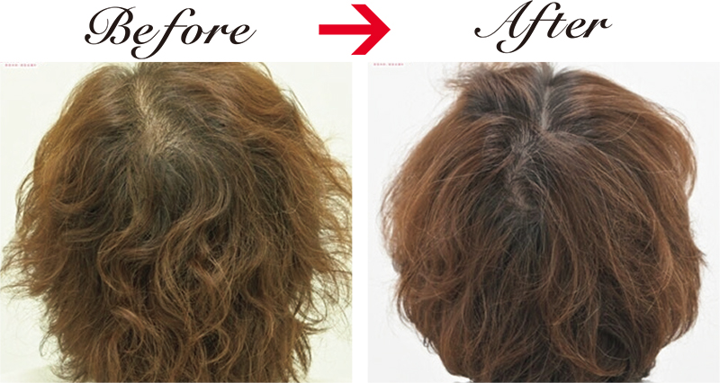 分け目が目立たなくなり、毛量がアップ。Folixを5回照射した54才女性。半年後には髪全体のボリュームと頭頂部の透け感が改善。1回4万9900円